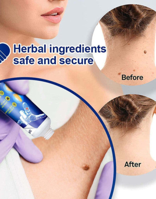 Warts Remover Cream Extract Skin Face Tags Extract Corn Treatment Ointment Painless ( Pack Of 2 )